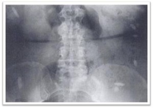 pills remained in gut
